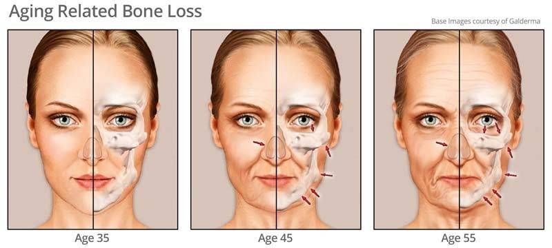 age-related-bone-loss-face