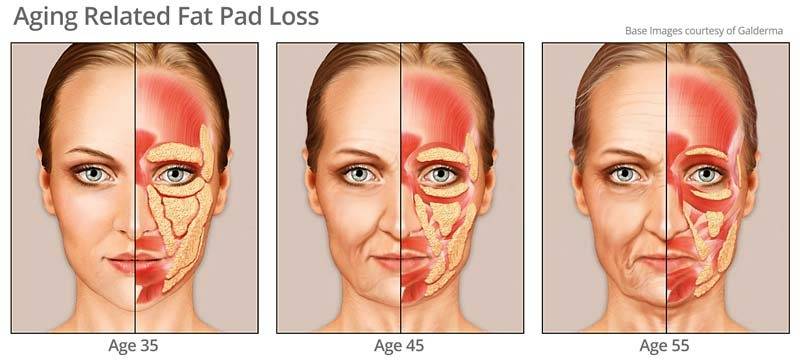 age-related-fat-pad-loss-face